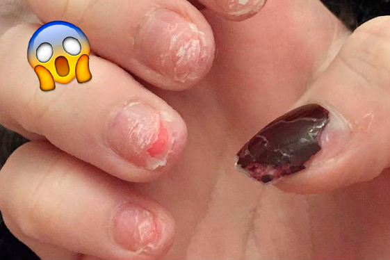 Blogueira mostra unhas detonadas por causa de postiças. Ai!