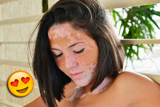 Modelo com vitiligo faz campanha linda pra falar sobre o assunto