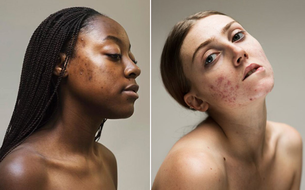 Com espinhas, manchas… Fotos destacam beleza de diferentes tipos de pele