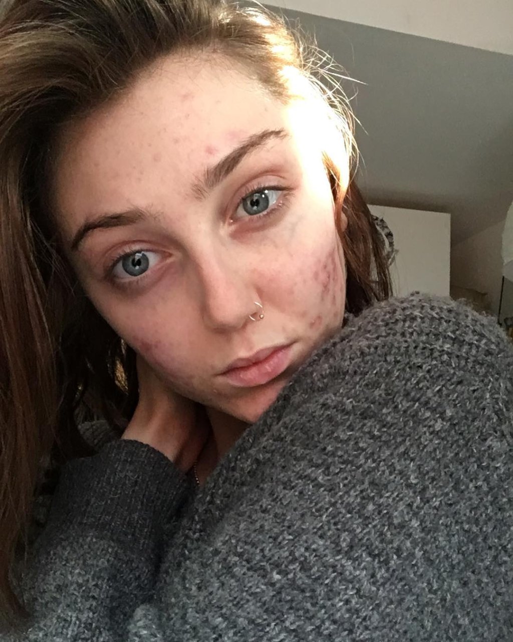 modelo-acne-espinhas-hashtag