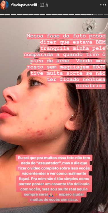 flavia-pavanelli-tratamento-acne-4 flavia-pavanelli-tratamento-acne-4