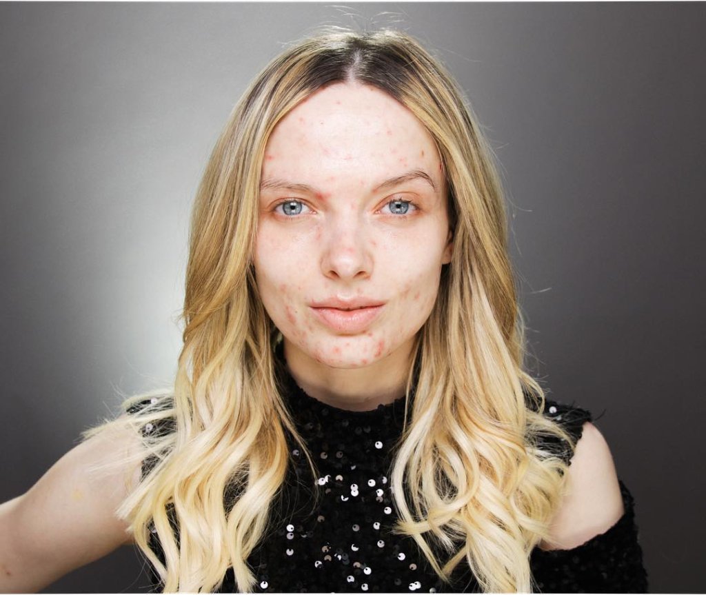 Marca de make americana usa modelo com acne em anúncio e causa polêmica