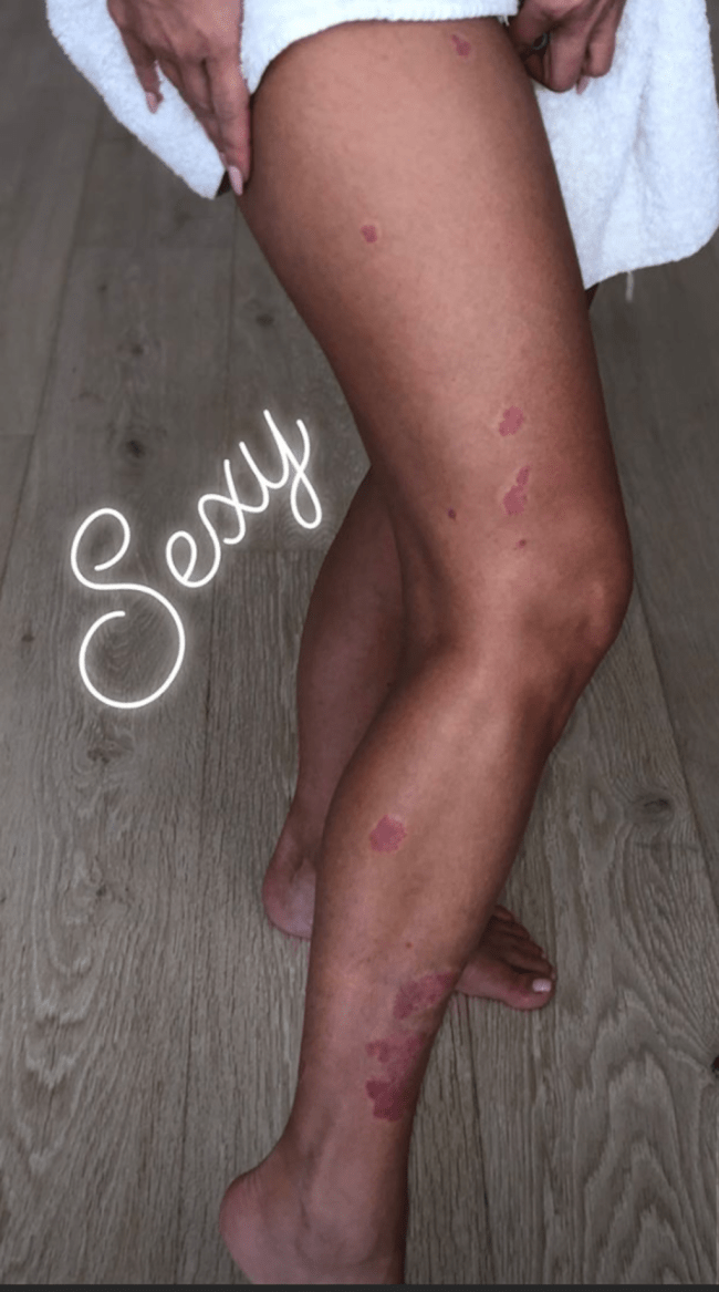 kim-kardashian-psoriase kim-kardashian-psoriase