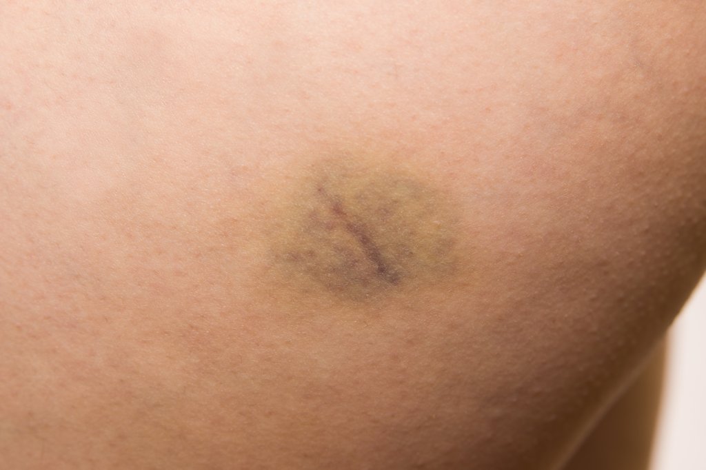 Caso Neymar: hematomas em vítima estão registrados em laudo médico