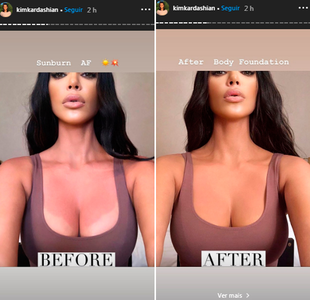 kim-kardashian-queimadura-sol-antes-e-depois