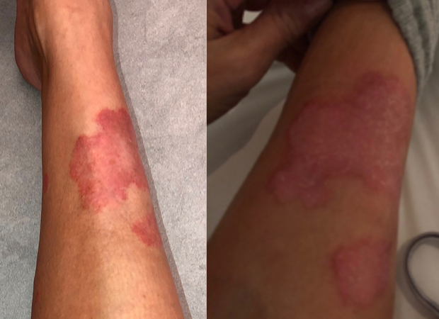 kim-kardashian-pele-psoriase