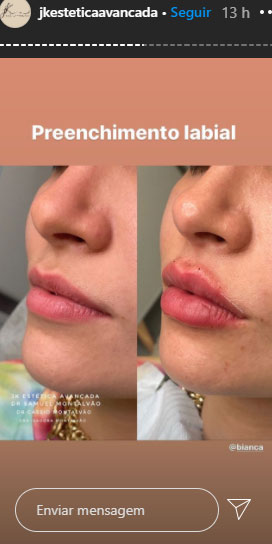 bianca-andrade-procedimentos-esteticos-1 bianca-andrade-procedimentos-esteticos-1