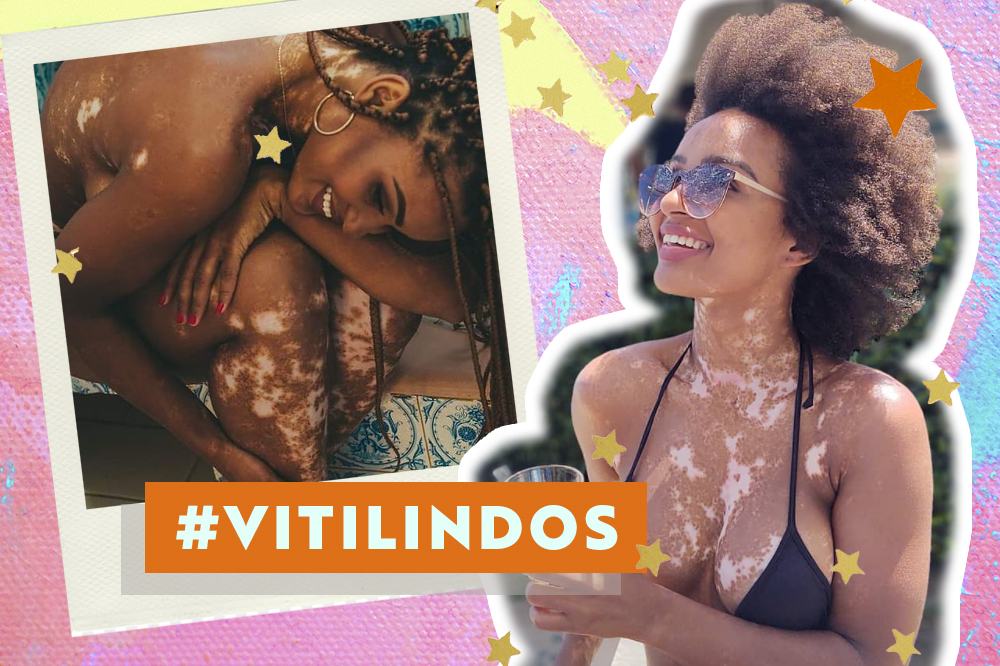 Vitiligo: especialista derruba estigmas sobre a doença da Natália do BBB22