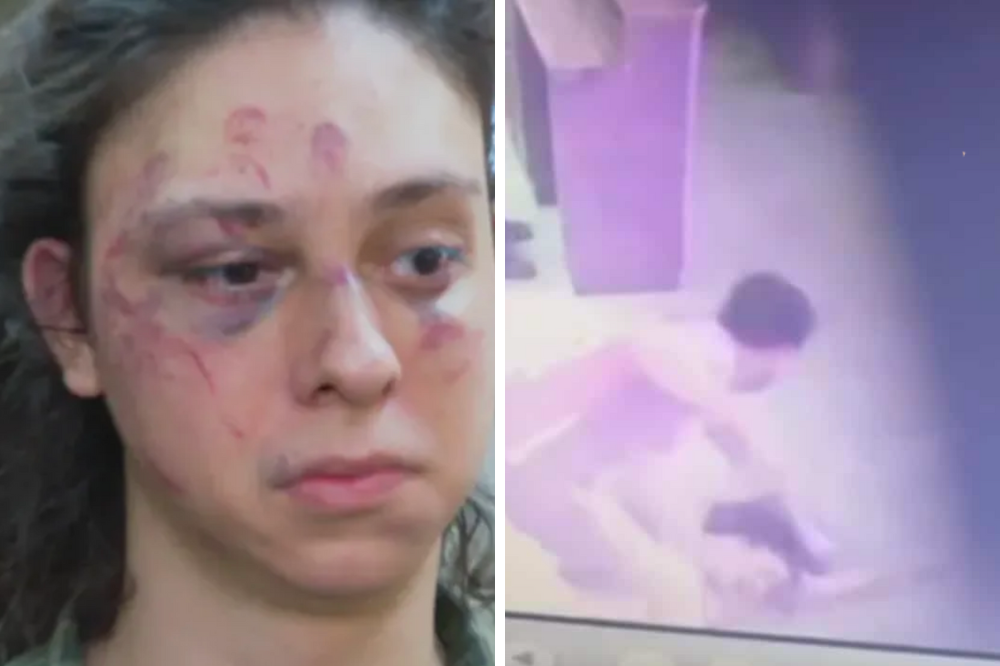 Pessoa apresenta hematomas e machucados no rosto