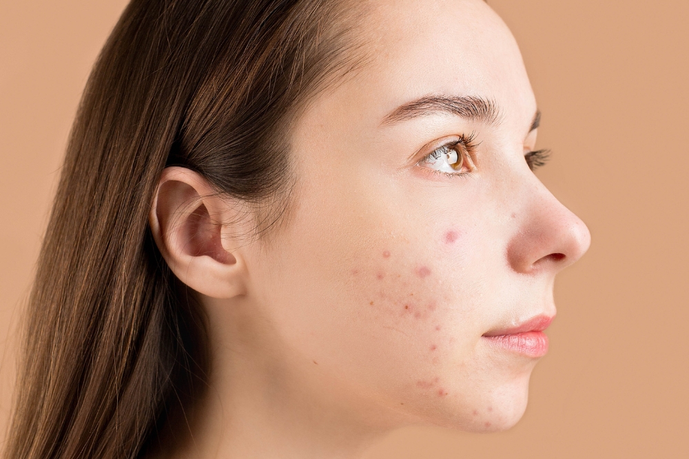 O que é acne, problema de pele super frequente na adolescência