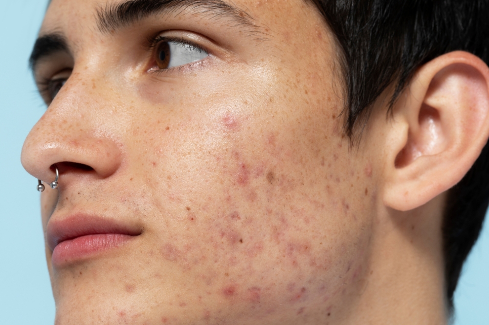 Quais são os tipos de acne e os tratamentos indicados