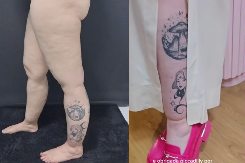 O que é lipedema? Veja os sintomas, tratamentos e como funciona a cirurgia