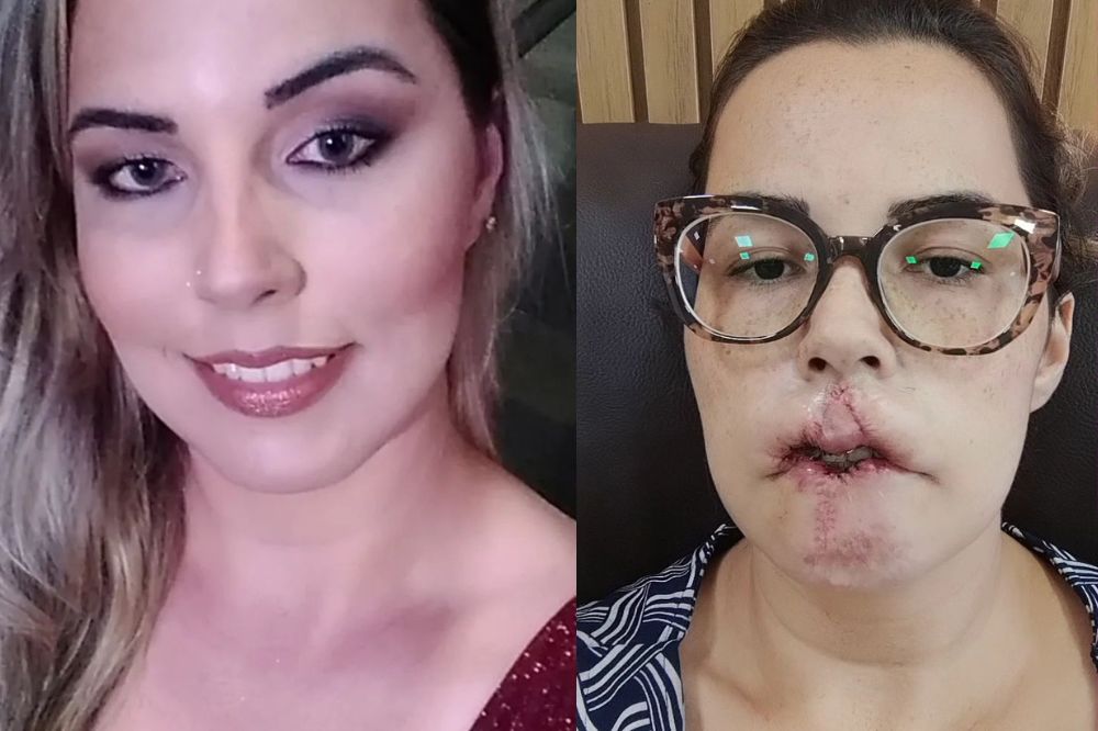 Mulher que perdeu o lábio após preenchimento busca apoio nas redes sociais