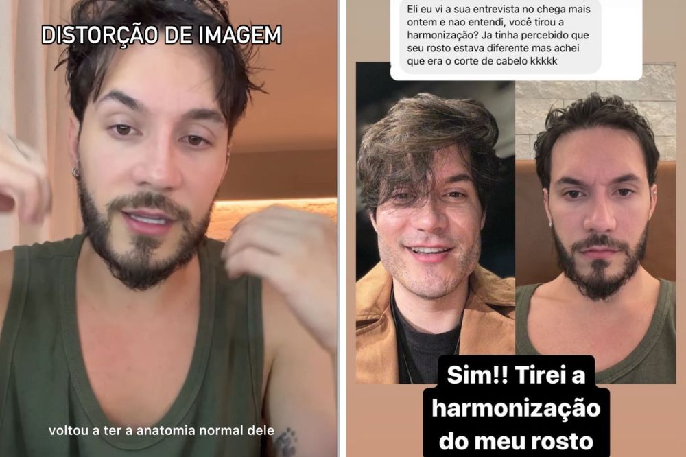 Eliezer retira harmonização facial após perceber a distorção de imagem